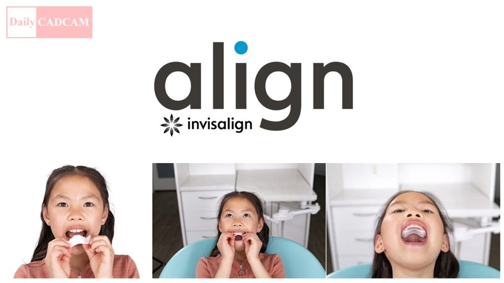 Align’s Invisalign Palatal Expander System for Skeletal, Dental ...